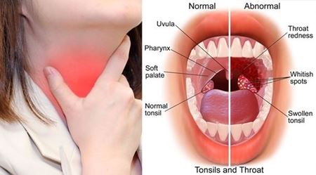 Picture for category Tonsilitis & Throat Pain