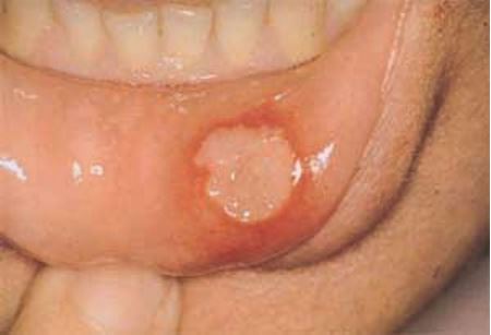 Picture for category Mouth Ulcers/Aphthae