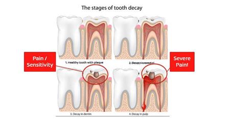Picture for category Cavities & Tooth Pain